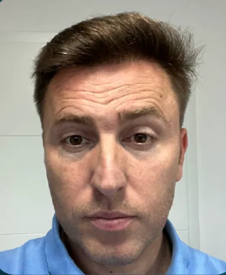 After — FUE Hair Transplant