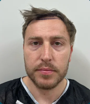 Before — FUE Hair Transplant