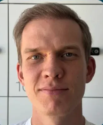 After — DHI Hair Transplant