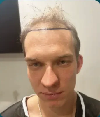 Before — DHI Hair Transplant