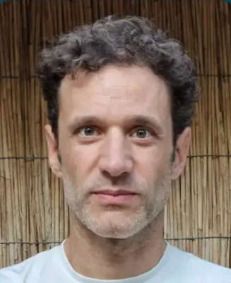 After — FUE Hair Transplant