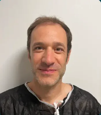 Before — FUE Hair Transplant