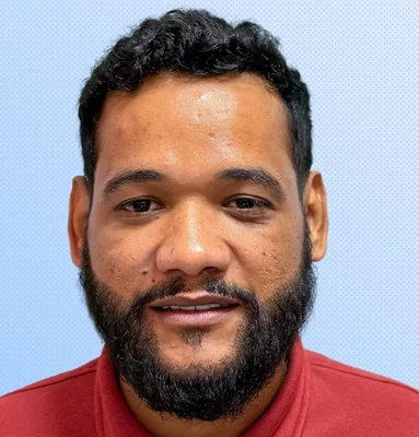After — Hair Transplant
