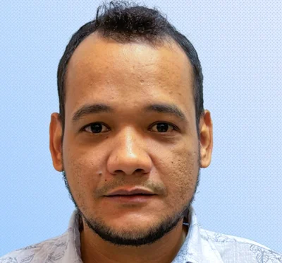 Before — Hair Transplant