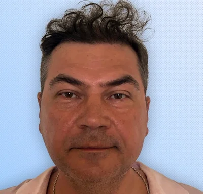 After — Hair Transplant