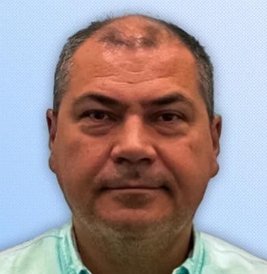 Before — Hair Transplant