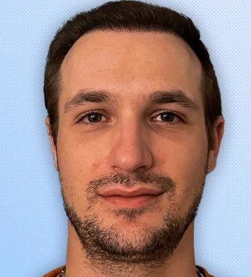 After — Hair Transplant