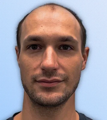 Before — Hair Transplant