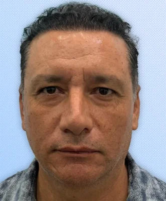 After — Hair Transplant
