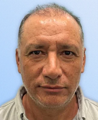 Before — Hair Transplant