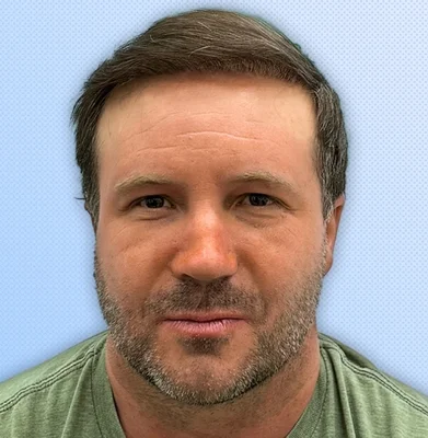 After — Hair Transplant