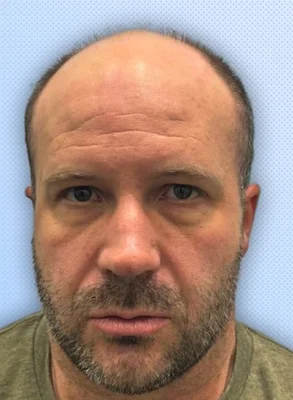 Before — Hair Transplant