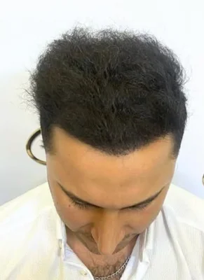 After — Hair Transplant
