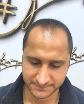 Before — Hair Transplant