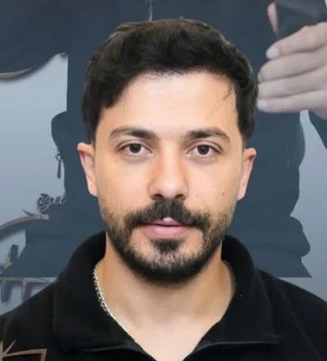After — Hair Transplant