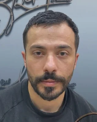 Before — Hair Transplant