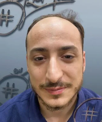 Before — Hair Transplant