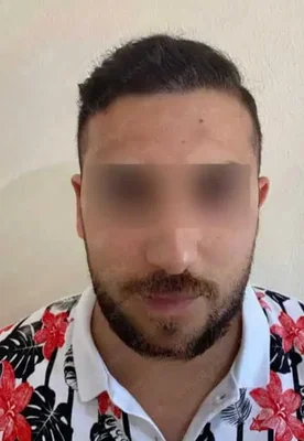 After — Hair Transplant