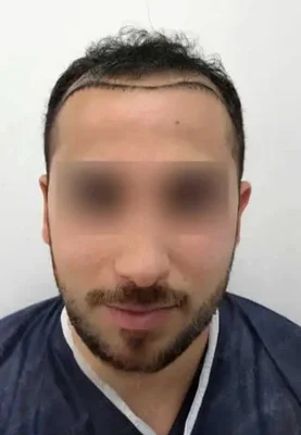 Before — Hair Transplant