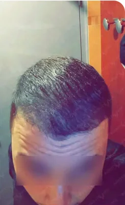 After — Hair Transplant