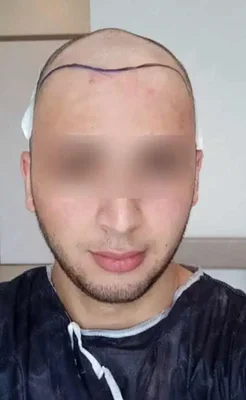 Before — Hair Transplant