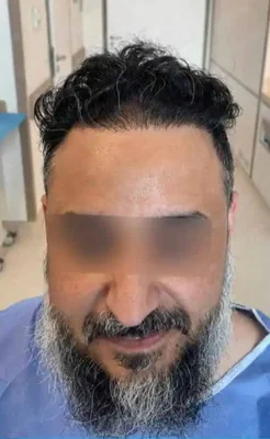 After — Hair Transplant
