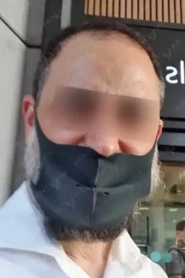 Before — Hair Transplant