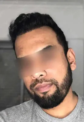 After — Hair Transplant