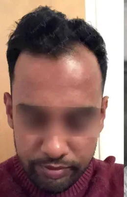 Before — Hair Transplant