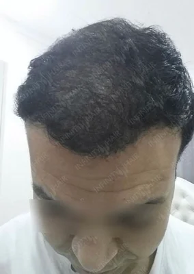 After — Hair Transplant