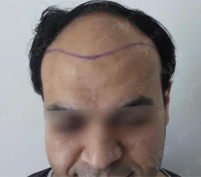 Before — Hair Transplant