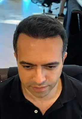 After — Sapphire FUE Hair Transplant