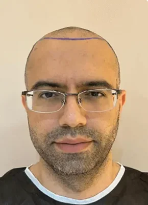 Before — Sapphire FUE Hair Transplant