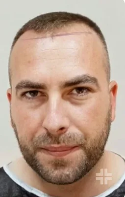 Before — Dhi-Choi (pen) Technique Hair Transplant