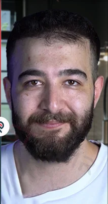 After — Hair Transplant