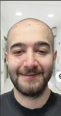Before — Hair Transplant