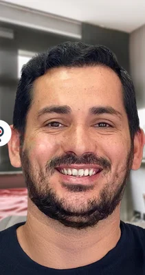 After — Hair Transplant