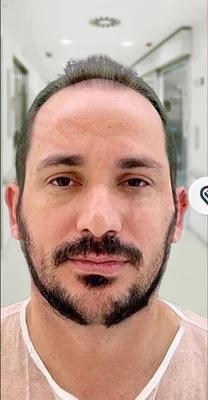 Before — Hair Transplant
