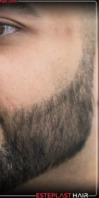 After — Beard Transplant