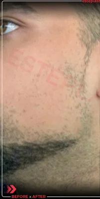 Before — Beard Transplant