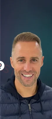 After — Hair Transplant