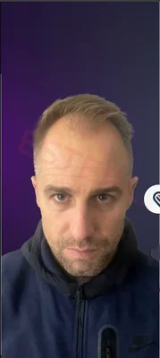 Before — Hair Transplant