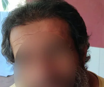 After — Hair Transplant