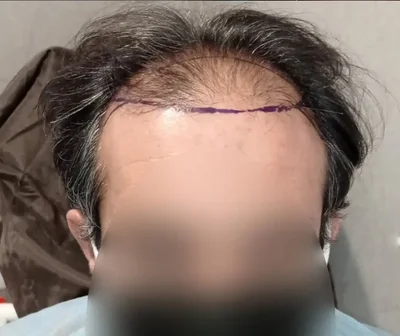 Before — Hair Transplant