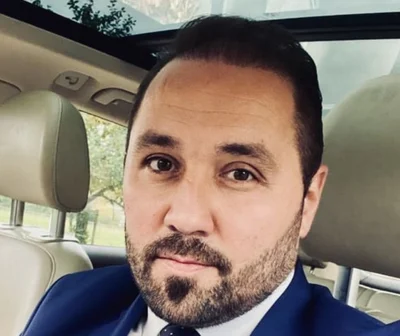 After — Hair Transplant