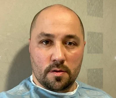 Before — Hair Transplant