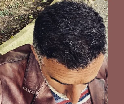 After — Hair Transplant