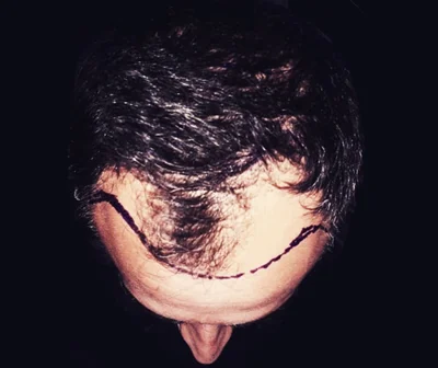 Before — Hair Transplant