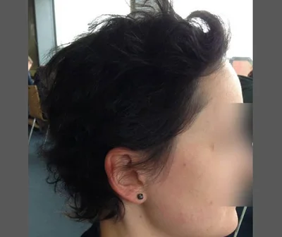 After — Hair Transplant