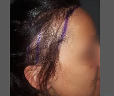 Before — Hair Transplant